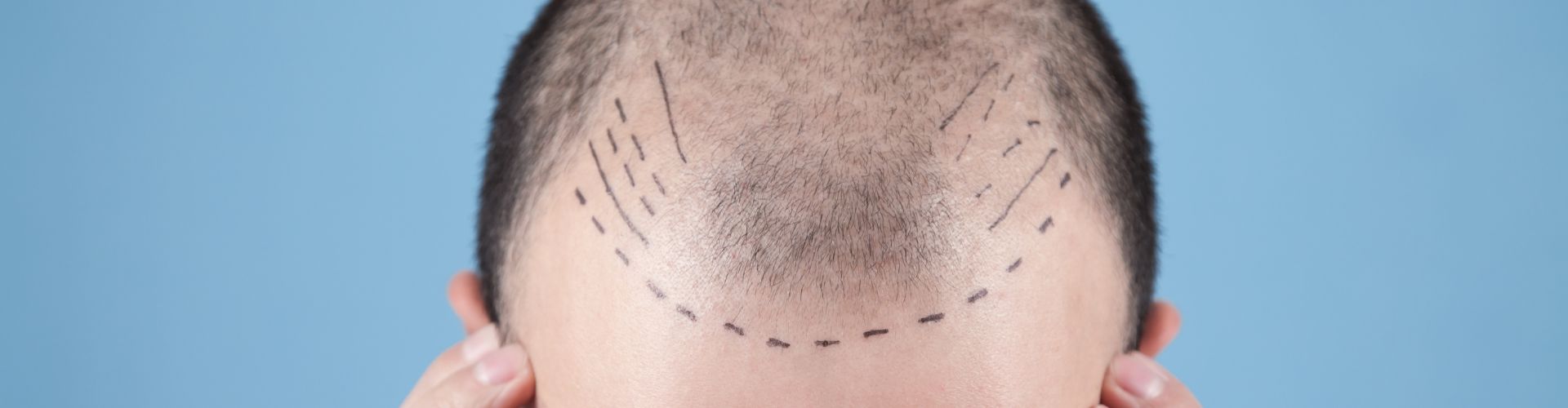 recomendaciones antes de un injerto capilar