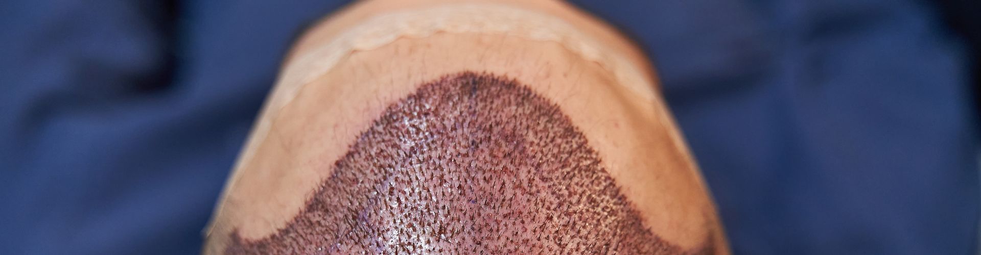 consejos tras un trasplante capilar